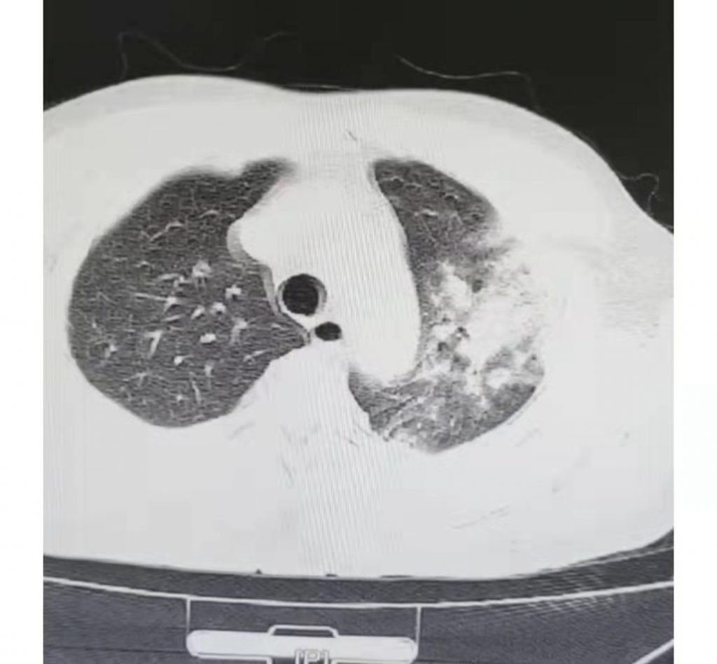 图片[14]-非典型病原体之鹦鹉热衣原体肺炎影像特点与临床 | 每周呼吸-每周呼吸
