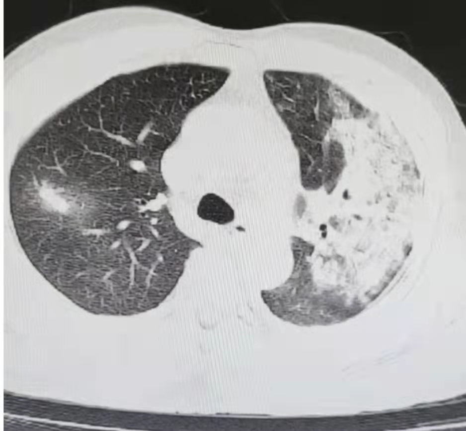 图片[16]-非典型病原体之鹦鹉热衣原体肺炎影像特点与临床 | 每周呼吸-每周呼吸