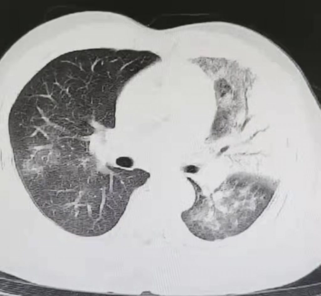 图片[17]-非典型病原体之鹦鹉热衣原体肺炎影像特点与临床 | 每周呼吸-每周呼吸