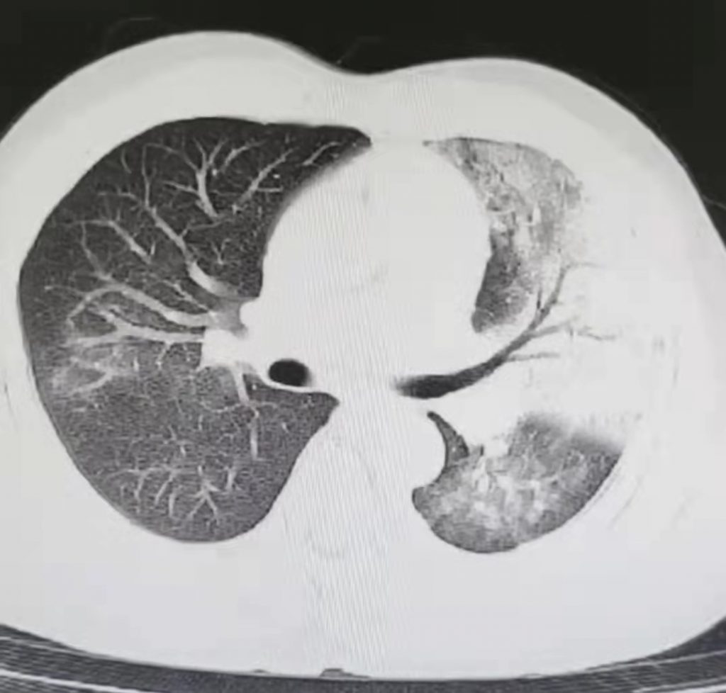 图片[18]-非典型病原体之鹦鹉热衣原体肺炎影像特点与临床 | 每周呼吸-每周呼吸