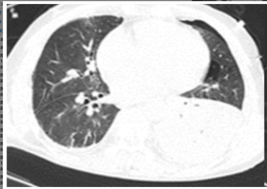 图片[2]-非典型病原体之鹦鹉热衣原体肺炎影像特点与临床 | 每周呼吸-每周呼吸