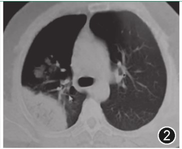 图片[3]-非典型病原体之鹦鹉热衣原体肺炎影像特点与临床 | 每周呼吸-每周呼吸