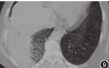 图片[4]-非典型病原体之鹦鹉热衣原体肺炎影像特点与临床 | 每周呼吸-每周呼吸