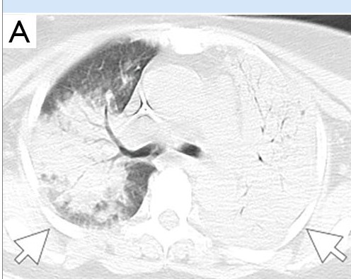 图片[5]-非典型病原体之鹦鹉热衣原体肺炎影像特点与临床 | 每周呼吸-每周呼吸