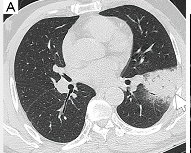 图片[6]-非典型病原体之鹦鹉热衣原体肺炎影像特点与临床 | 每周呼吸-每周呼吸