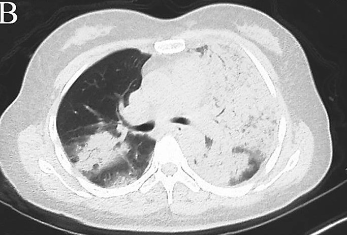 图片[7]-非典型病原体之鹦鹉热衣原体肺炎影像特点与临床 | 每周呼吸-每周呼吸