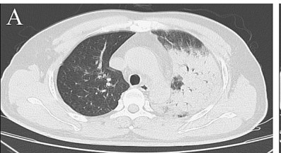 图片[9]-非典型病原体之鹦鹉热衣原体肺炎影像特点与临床 | 每周呼吸-每周呼吸