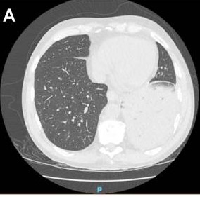 图片[8]-非典型病原体之鹦鹉热衣原体肺炎影像特点与临床 | 每周呼吸-每周呼吸