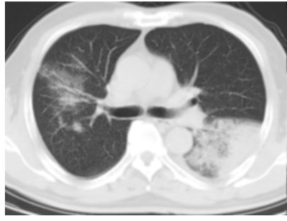 图片[10]-非典型病原体之鹦鹉热衣原体肺炎影像特点与临床 | 每周呼吸-每周呼吸