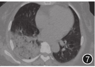 图片[11]-非典型病原体之鹦鹉热衣原体肺炎影像特点与临床 | 每周呼吸-每周呼吸