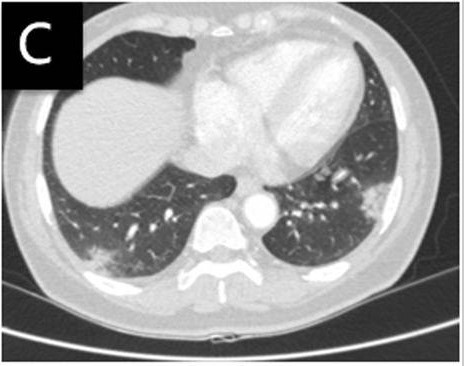 图片[12]-非典型病原体之鹦鹉热衣原体肺炎影像特点与临床 | 每周呼吸-每周呼吸