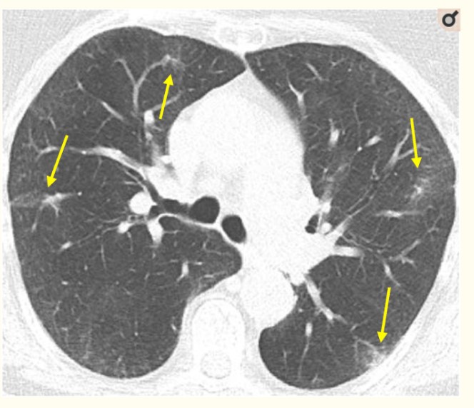 图片[13]-非典型病原体之鹦鹉热衣原体肺炎影像特点与临床 | 每周呼吸-每周呼吸