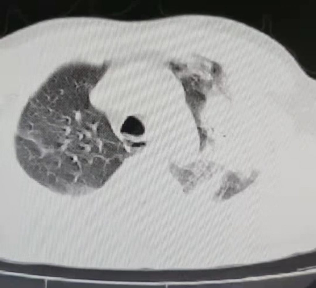 图片[19]-非典型病原体之鹦鹉热衣原体肺炎影像特点与临床 | 每周呼吸-每周呼吸