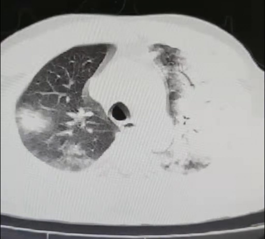 图片[20]-非典型病原体之鹦鹉热衣原体肺炎影像特点与临床 | 每周呼吸-每周呼吸