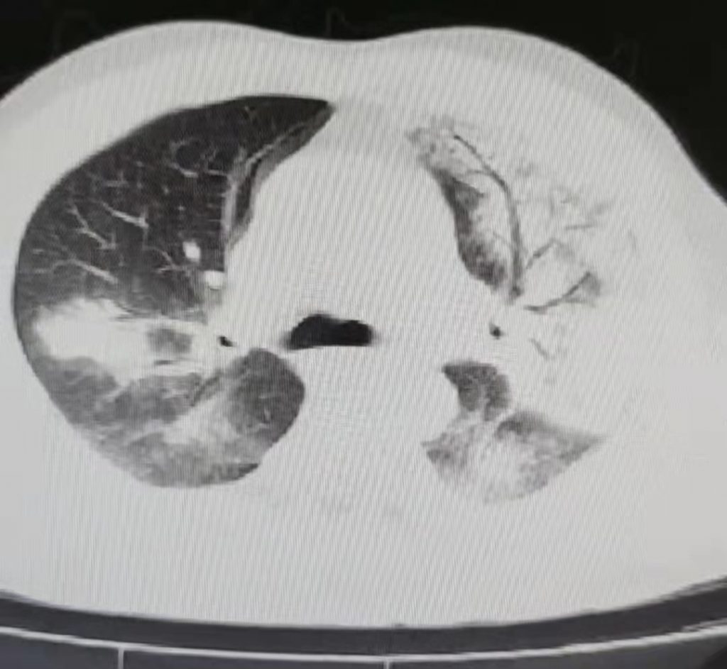 图片[21]-非典型病原体之鹦鹉热衣原体肺炎影像特点与临床 | 每周呼吸-每周呼吸