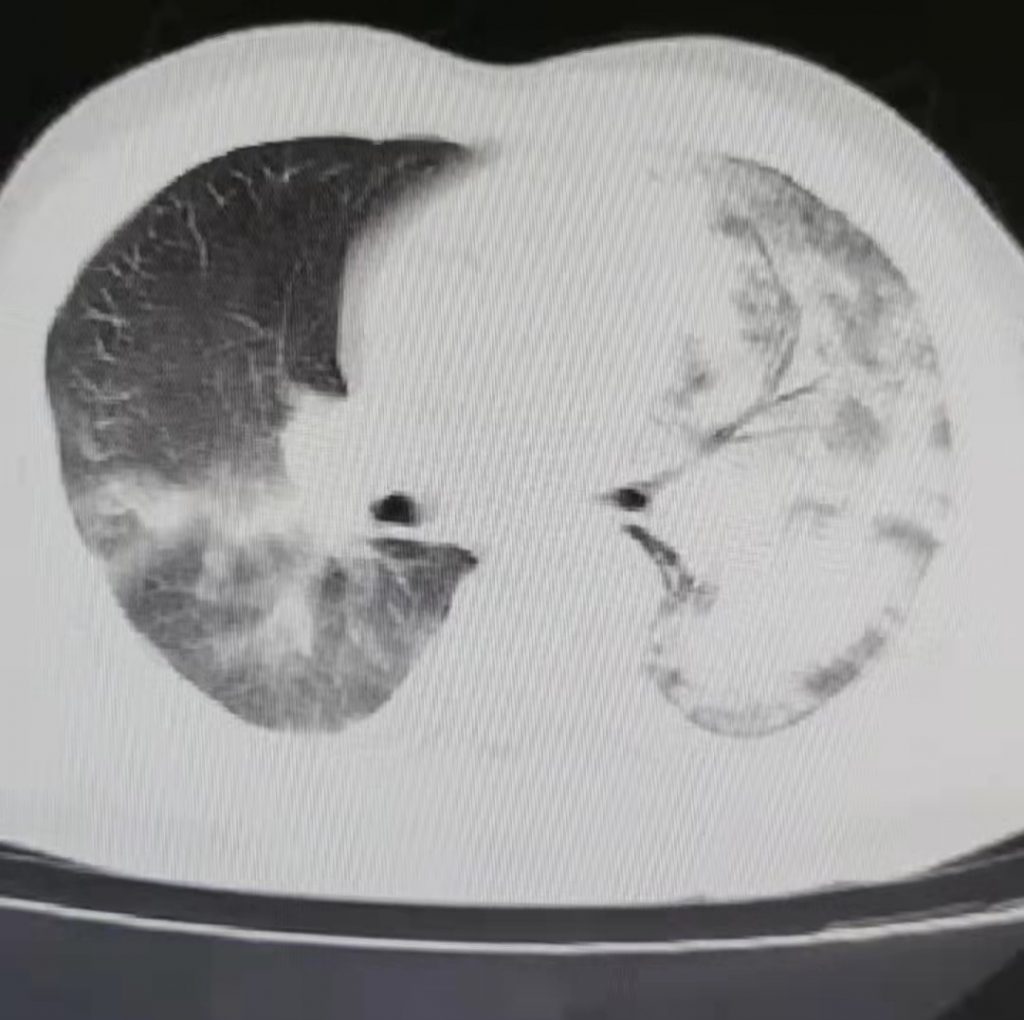 图片[22]-非典型病原体之鹦鹉热衣原体肺炎影像特点与临床 | 每周呼吸-每周呼吸