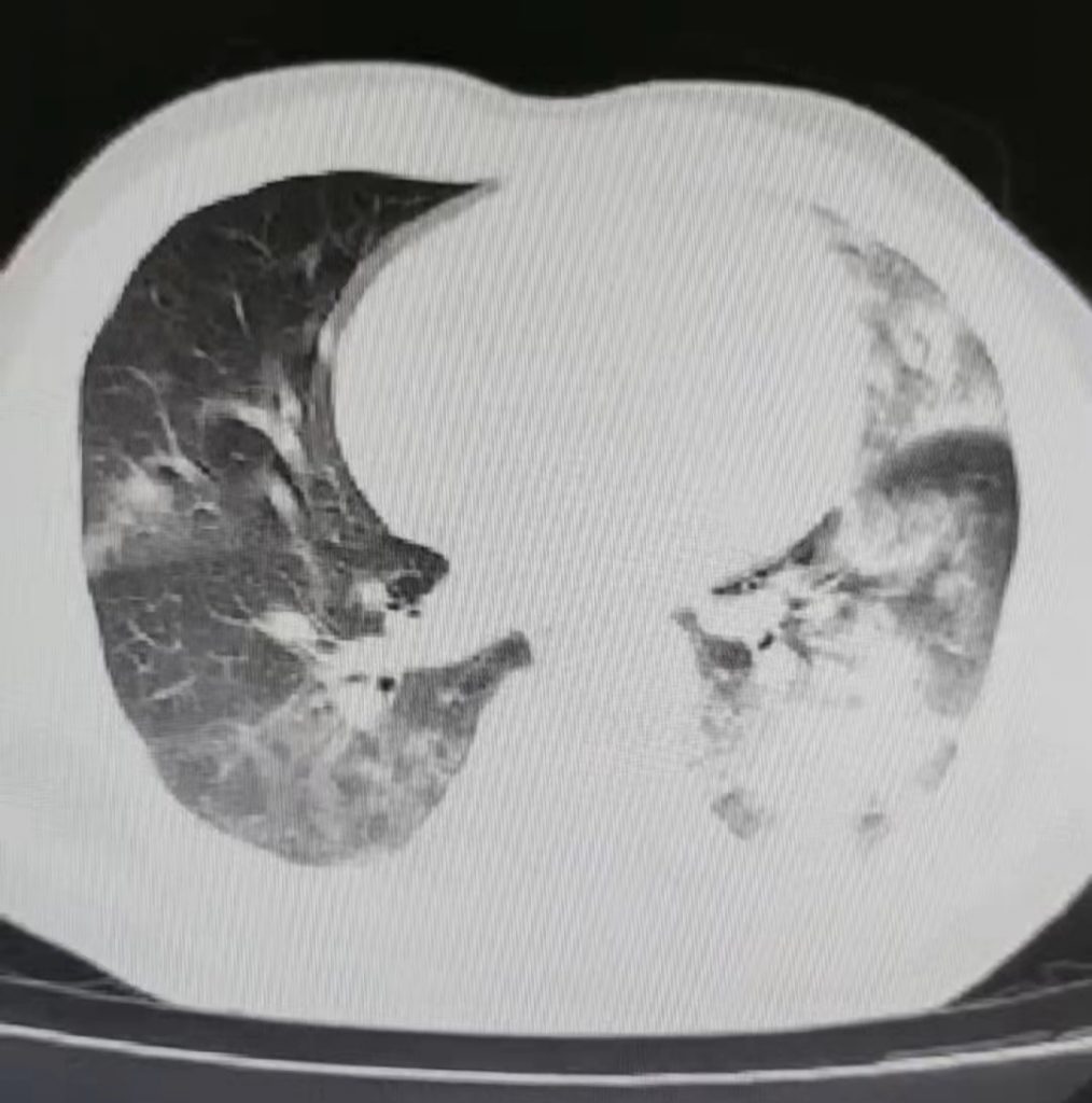 图片[23]-非典型病原体之鹦鹉热衣原体肺炎影像特点与临床 | 每周呼吸-每周呼吸