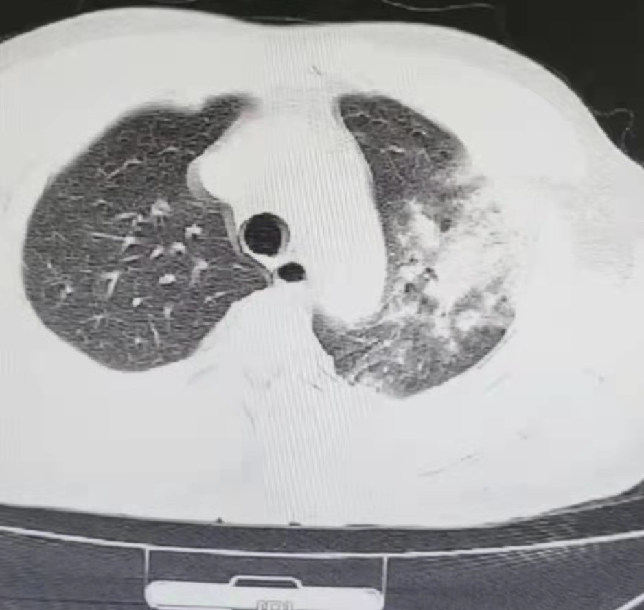 图片[15]-非典型病原体之鹦鹉热衣原体肺炎影像特点与临床 | 每周呼吸-每周呼吸