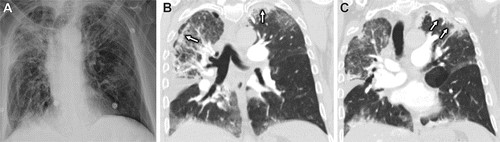 图片[26]-药物相关性肺损伤，这篇综述就够了！ | 每周呼吸-每周呼吸