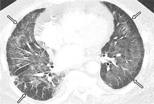 图片[11]-药物相关性肺损伤，这篇综述就够了！ | 每周呼吸-每周呼吸
