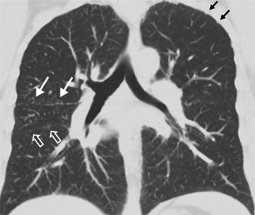图片[12]-药物相关性肺损伤，这篇综述就够了！ | 每周呼吸-每周呼吸