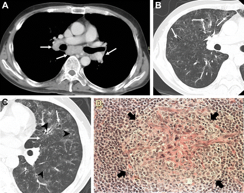图片[10]-人类致瘤病毒和胸部肿瘤影像学表现 | 每周呼吸-每周呼吸