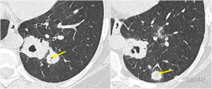 图片[9]-肺部ANCA相关血管炎的分类标准与影像特点 | 每周呼吸-每周呼吸