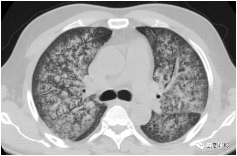 图片[10]-肺部ANCA相关血管炎的分类标准与影像特点 | 每周呼吸-每周呼吸