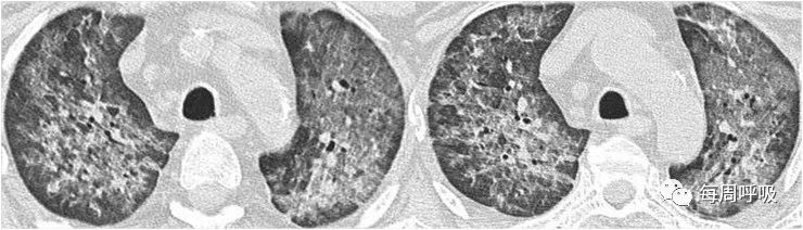 图片[11]-肺部ANCA相关血管炎的分类标准与影像特点 | 每周呼吸-每周呼吸