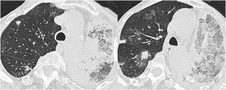 图片[12]-肺部ANCA相关血管炎的分类标准与影像特点 | 每周呼吸-每周呼吸