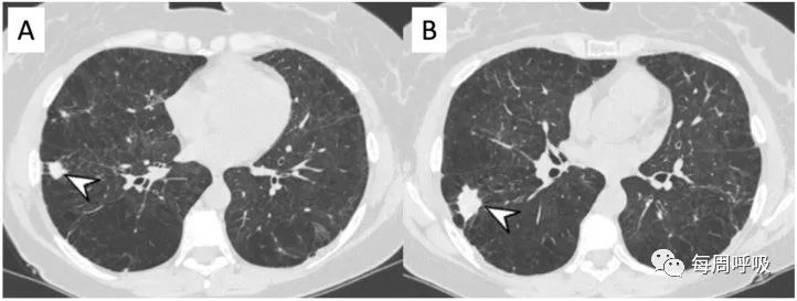 图片[14]-肺部ANCA相关血管炎的分类标准与影像特点 | 每周呼吸-每周呼吸