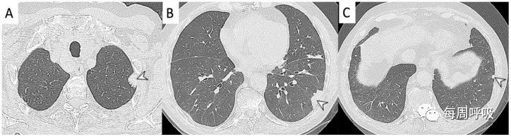 图片[15]-肺部ANCA相关血管炎的分类标准与影像特点 | 每周呼吸-每周呼吸