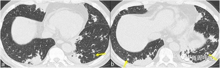 图片[16]-肺部ANCA相关血管炎的分类标准与影像特点 | 每周呼吸-每周呼吸