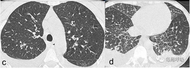 图片[17]-肺部ANCA相关血管炎的分类标准与影像特点 | 每周呼吸-每周呼吸