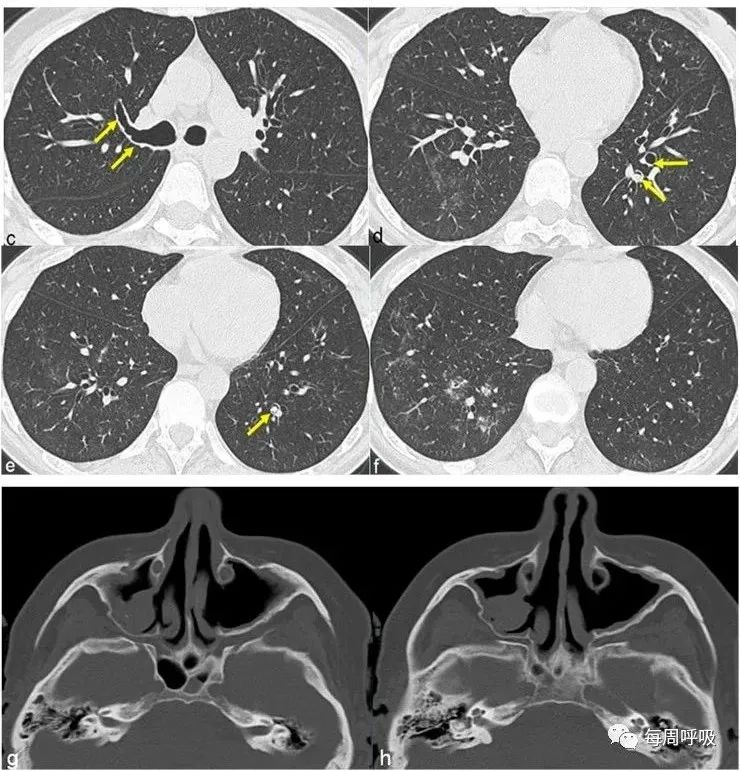 图片[18]-肺部ANCA相关血管炎的分类标准与影像特点 | 每周呼吸-每周呼吸