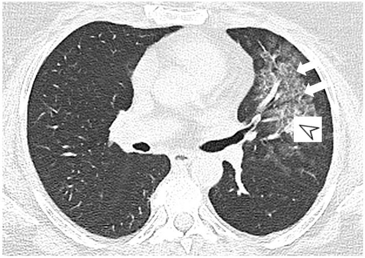 图片[1]-肺部ANCA相关血管炎的分类标准与影像特点 | 每周呼吸-每周呼吸