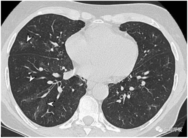 图片[2]-肺部ANCA相关血管炎的分类标准与影像特点 | 每周呼吸-每周呼吸