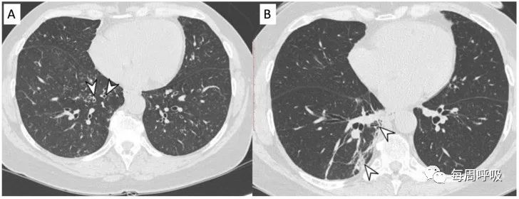 图片[3]-肺部ANCA相关血管炎的分类标准与影像特点 | 每周呼吸-每周呼吸