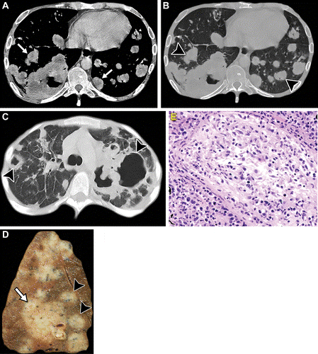 图片[4]-人类致瘤病毒和胸部肿瘤影像学表现 | 每周呼吸-每周呼吸