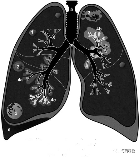 图片[4]-肺部ANCA相关血管炎的分类标准与影像特点 | 每周呼吸-每周呼吸