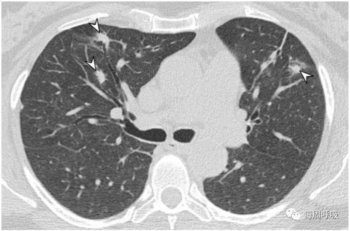 图片[5]-肺部ANCA相关血管炎的分类标准与影像特点 | 每周呼吸-每周呼吸