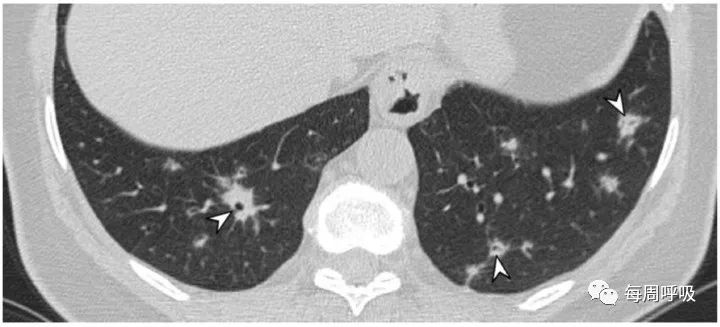 图片[6]-肺部ANCA相关血管炎的分类标准与影像特点 | 每周呼吸-每周呼吸