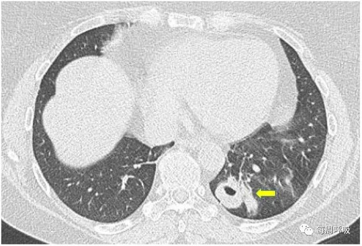图片[7]-肺部ANCA相关血管炎的分类标准与影像特点 | 每周呼吸-每周呼吸