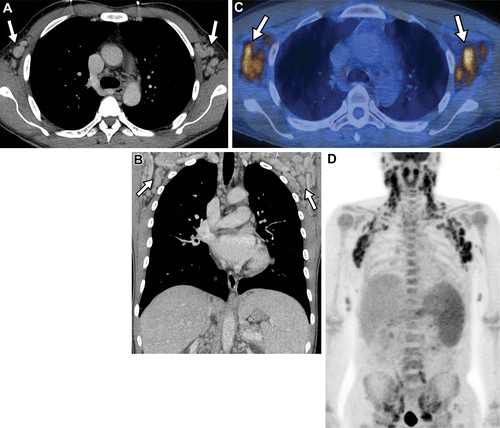图片[9]-人类致瘤病毒和胸部肿瘤影像学表现 | 每周呼吸-每周呼吸