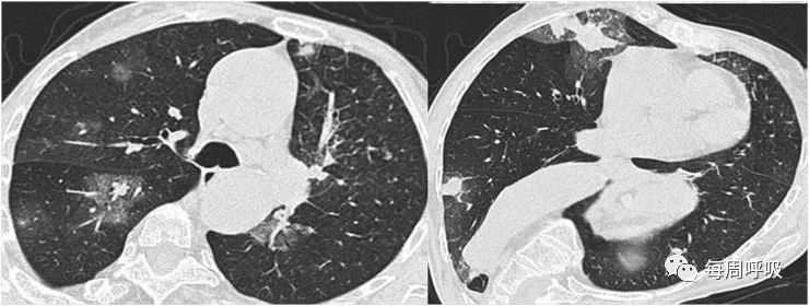 图片[8]-肺部ANCA相关血管炎的分类标准与影像特点 | 每周呼吸-每周呼吸