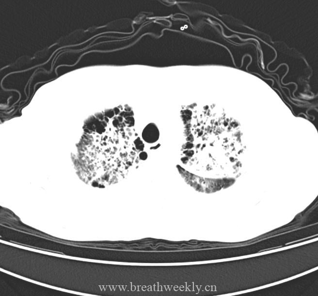 图片[4]-疑难病例 | 每周呼吸-每周呼吸