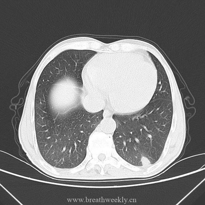 图片[7]-经典病例 | 每周呼吸-每周呼吸