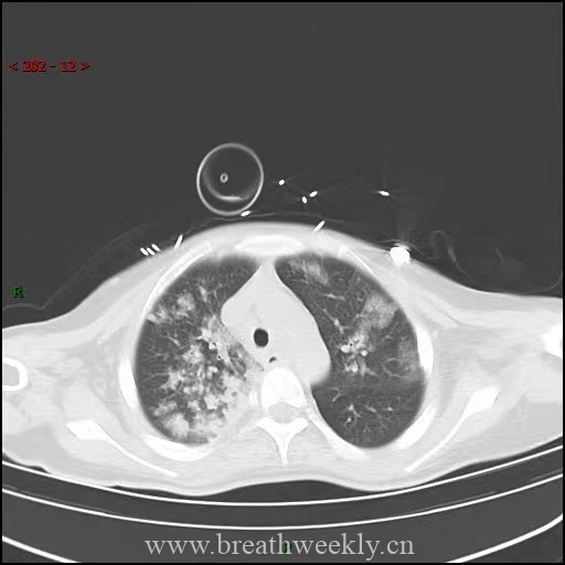 图片[6]-经典病例 | 每周呼吸-每周呼吸