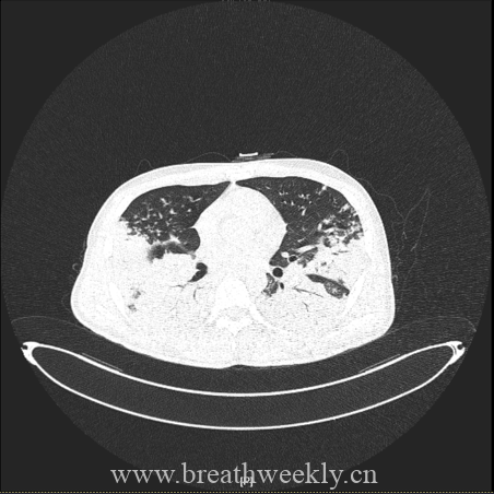 图片[16]-病例67 | 每周呼吸-每周呼吸