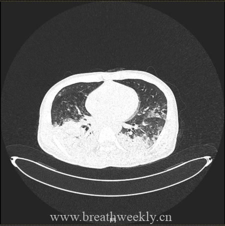 图片[3]-每周病例 | 每周呼吸-每周呼吸